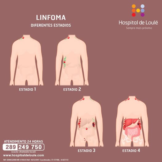 Lymphoma