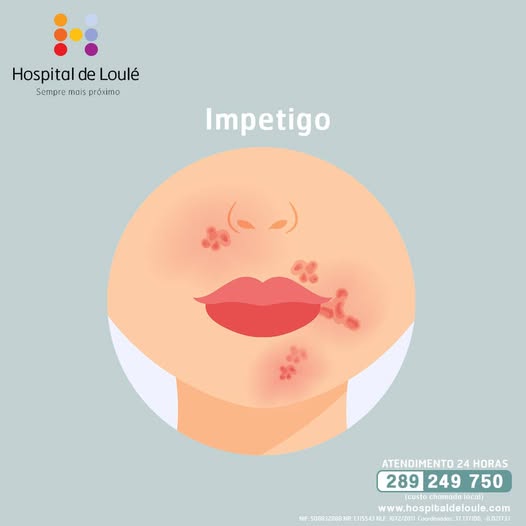 Sabe o que é o impetigo?